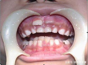 小孩的牙床上面多长了一个小牙齿是怎么回事 