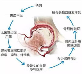 上海哪里治疗股骨头坏死好 上海看股骨头坏死哪里医院最好【★★】