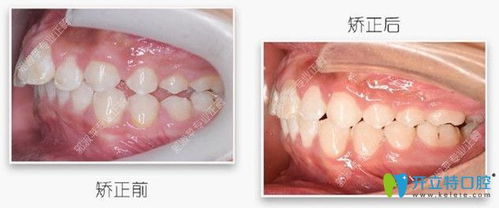深覆盖矫正经历证实 隐适美在推磨牙后移方面的效果不错