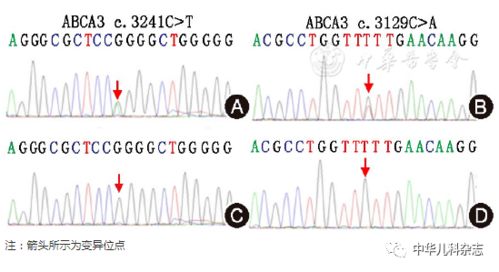 ABCA3基因复合杂合变异致儿童肺间质疾病一家系分析