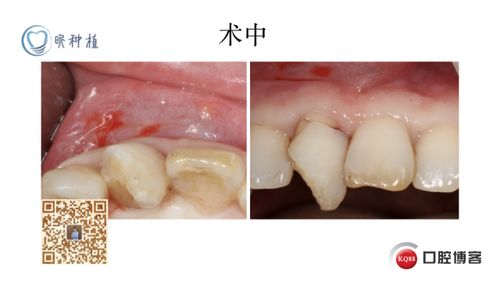 拔牙窝根片技术临床应用