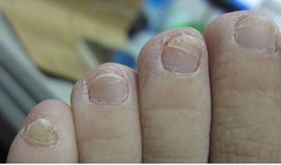 如何避免被传染灰指甲 