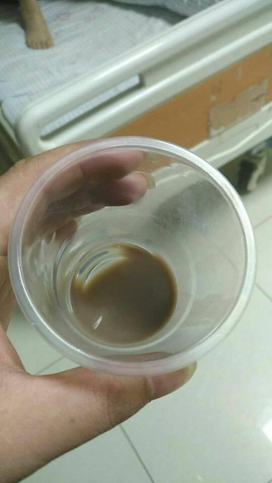 咖啡色尿液图片
