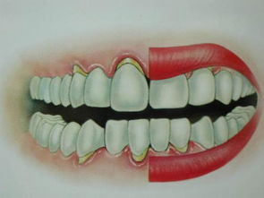 成人患有牙龈萎缩怎么治疗效果比较好 