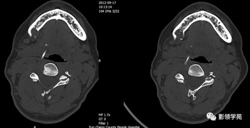 颌骨囊性常见病变的CT诊断