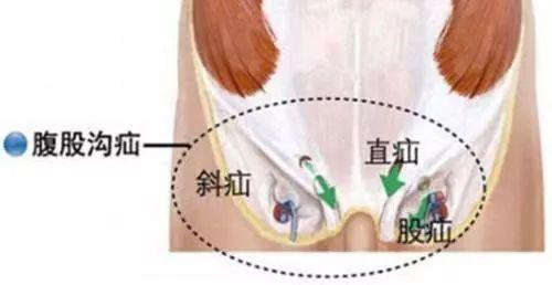 高发疝气该如何预防 权威专家在线科普,千万患者已受益