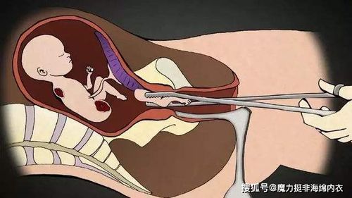 打胎时胎儿会疼吗