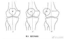 大部分膝盖疼痛与髌骨外移密切相关