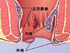 痔疮便血,会引起什么病发症