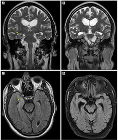 CNS感染的MRI表现第三弹 螺旋体 寄生虫感染