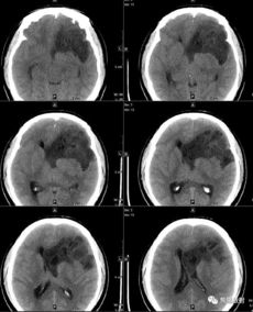 读片丨女30岁,间断性头痛 颅脑CT MRI