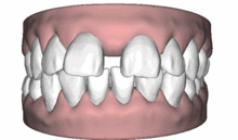 如果牙齿出现这6大情况,那么你需要矫牙了