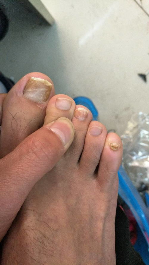 我脚上这是灰指甲吗 如果是怎么治疗 灰指甲会对身体造成什么样的 