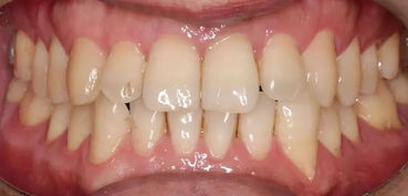 单颗前牙种植修复,如何考量美学评价标准 