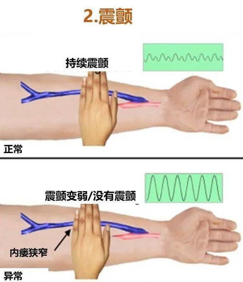 世界肾脏病日 重视血透通路管理,守护 生命通道