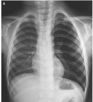 NEJM 患儿咳嗽时为何有口哨音 