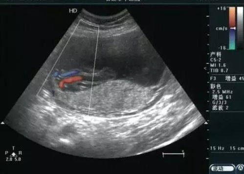 孕妇脐动脉sd正常值