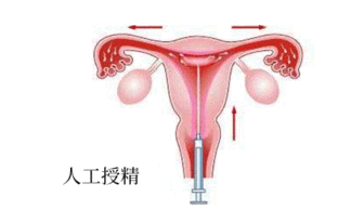 不明原因性不孕可以做人工授精吗