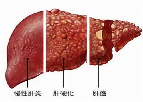 必知丨别把肝炎拖成肝癌 肝癌高危人群的筛查