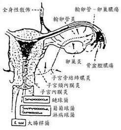 急性输卵管炎，简述急性输卵管炎的发病机制。