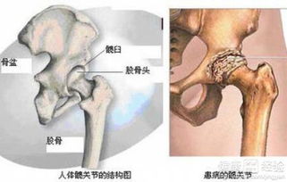 髋关节疼痛怎么治疗