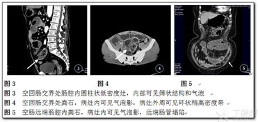 粪石性小肠梗阻MDCT诊断价值