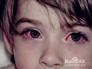 宝宝眼睛红肿 疑似红眼病 怎么处理