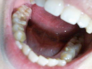 牙齿咬合不正,上牙前突,还有4颗小虎牙,上下各两颗,要怎么治 