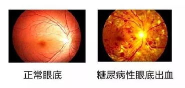 眼睛出现这5个症状,小心是双目失明的征兆