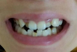 孩子几岁可以牙齿矫正