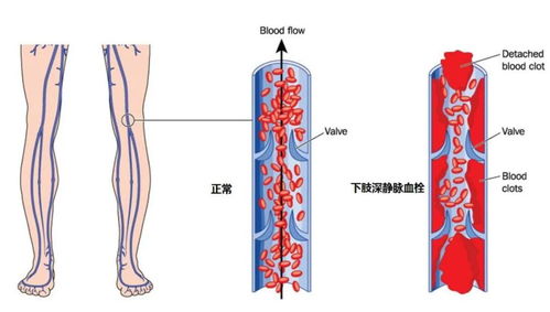 下肢深静脉血栓多长时间就不能在溶栓了(下肢深静脉血栓什么时候可以活动)