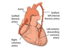 冠状动脉异常起源主动脉 