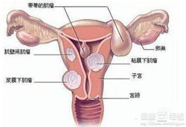 子宫肌瘤如何预防