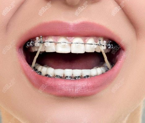 徐汇区牙齿矫正价目表 30岁戴金属牙套 儿童mrc正畸5200起