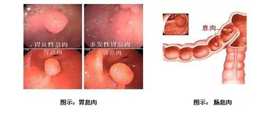 体检报告中的那些结节囊肿到底要不要治