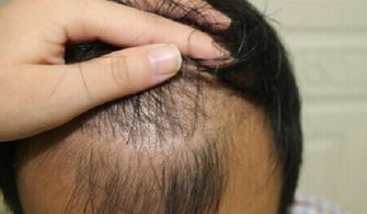 前额头发稀少的原因是什么 M型脱发,该如何治疗