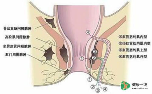 肛瘘的检查方法有几种 肛瘘有哪些检查项目