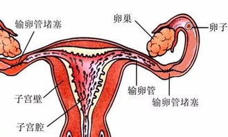 输卵管不通会出现哪些情况