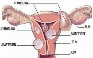 患子宫肌瘤可以怀孕吗 