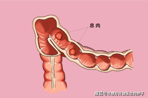 医生提醒 3个部位长息肉,最好尽早切除,以免招来癌症