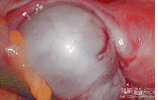 卵巢畸胎瘤是什么东西