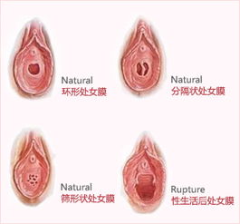 健康女性处女膜变化过程（图）