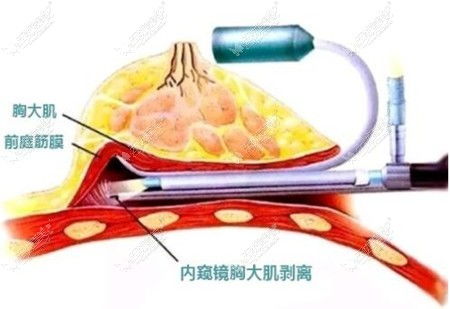 南京內窺鏡假體豐胸多少錢內窺鏡豐胸術有哪些優點 哪些人不適合內窺鏡豐胸手術 