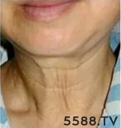 颈纹就是女人的 年轮 ,每增加十岁,脖子上就会多一道圈