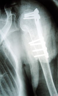 粉碎性骨折,粉碎性骨折:严重的外伤性损伤及其治疗