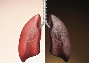 很多人都是这样改善!抽烟清肺空气污染是否是导致 肺癌 的元凶吸烟肺