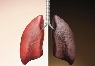 10年烟龄肺部图片图片