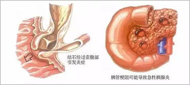 胆囊结石不是 小病 ,应及时手术,以防癌变