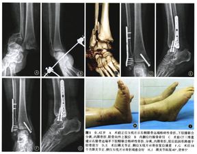 不可复位性踝关节骨折脱位一例 