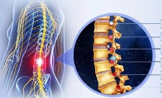 改善腰椎间盘突出,理疗瑜伽有方法